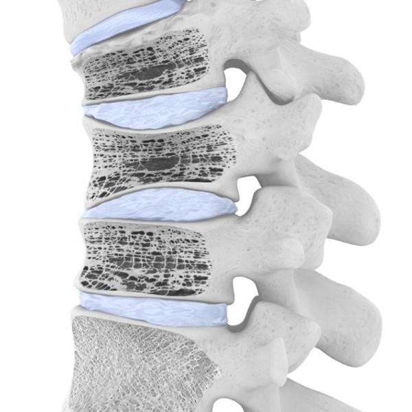 Spinal Osteoporosis