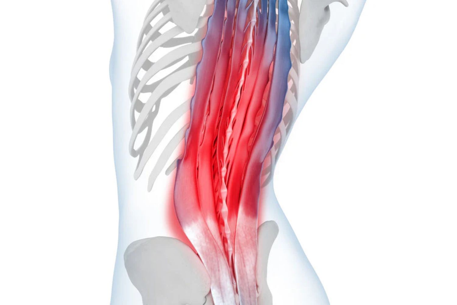 illustration of the back, see-through so that it shows the muscles and bones. The muscles along the spine are coloured bright red, indicating back pain and tension