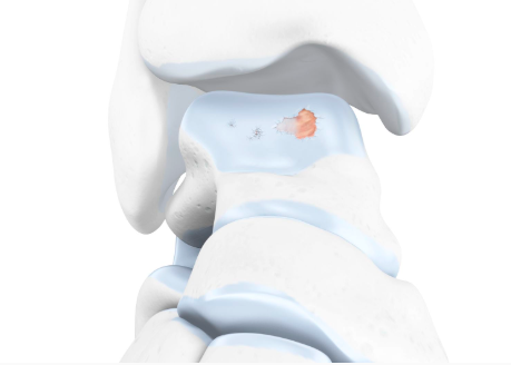 Illustration of the skeletal ankle. The image shows light blue cartilage with a red spot, indicating arthritis wear and tear