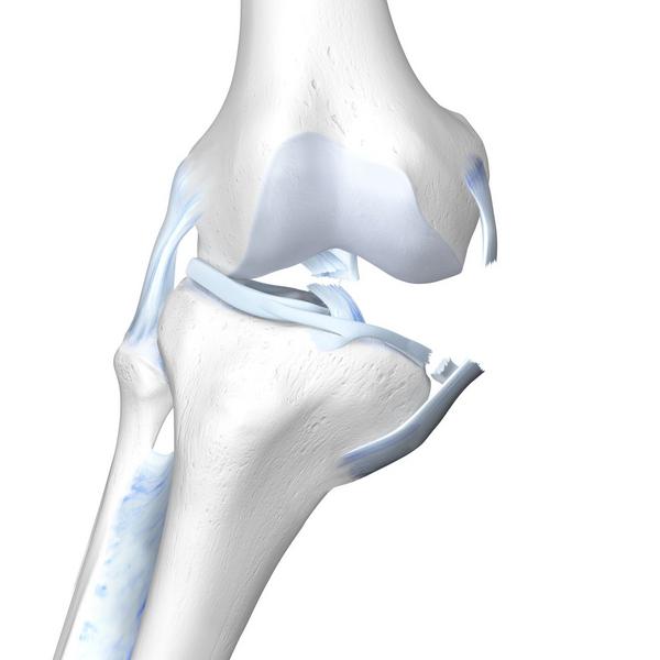 Unhappy Triad -  ACL, MCL, & Meniscus Damage