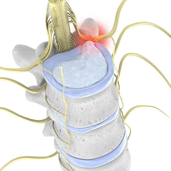 Disc Herniation | Bauerfeind New Zealand