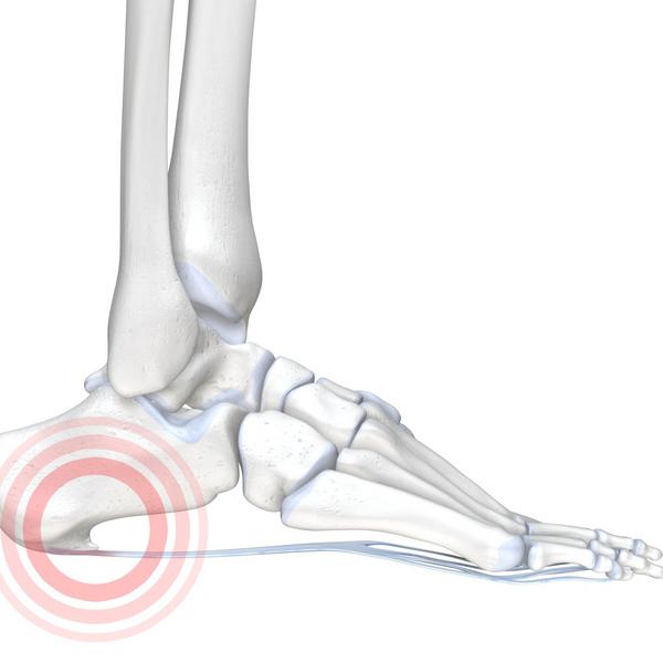 Heel Spurs - Bony Overgrowth of the Heel Bone