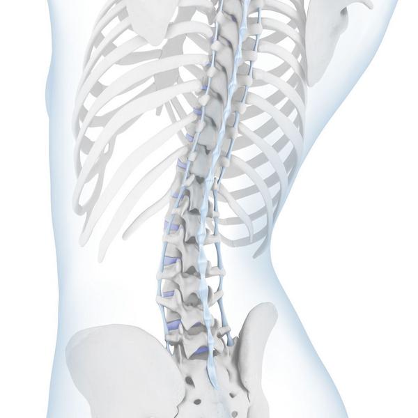 Hyperlordosis - Hollow Back