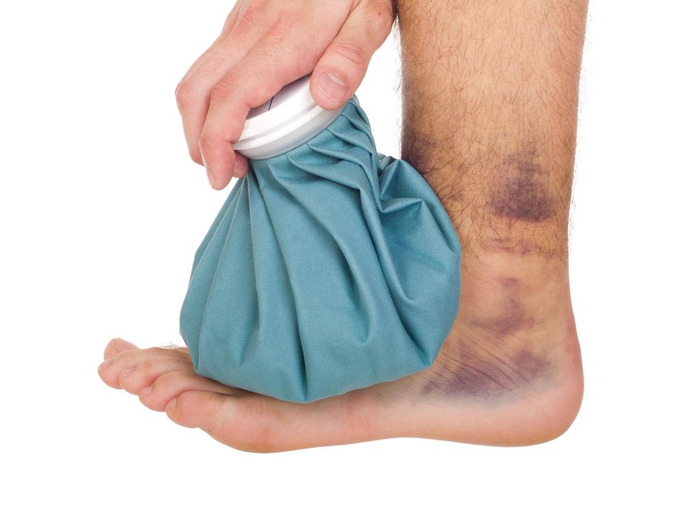3 Simple Solutions to Manage Ankle Swelling
