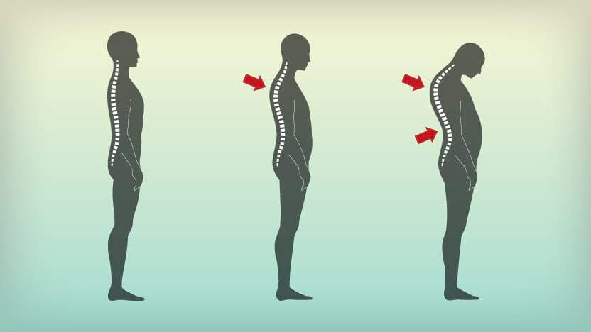 hyperkyphosis of the spine